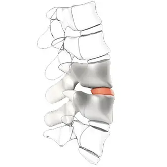 Intervertebral discs