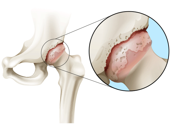 Arthrose
