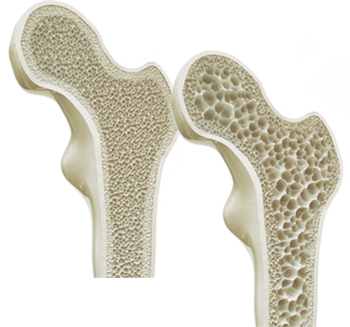Arthrose