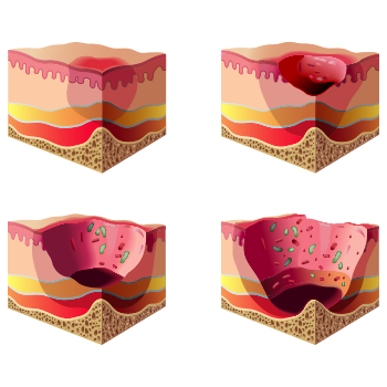 Arthrose