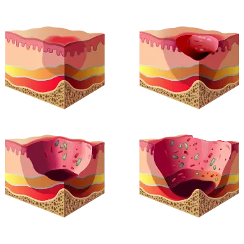 schematic wound